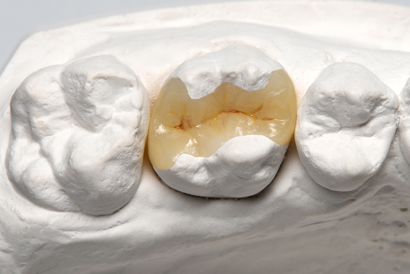 ハイブリッドインレー